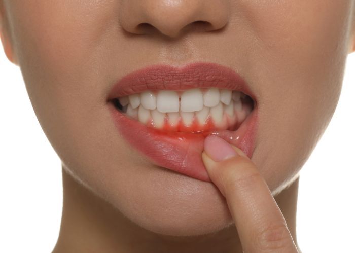 Cách nhận biết viêm lợi sau khi bọc răng sứ