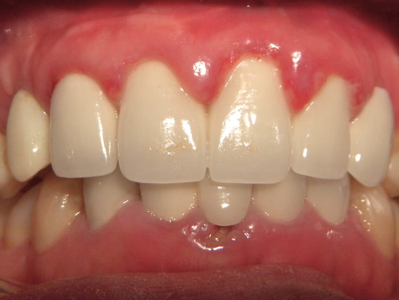 Dấu hiệu nhận biết răng sứ bị viêm