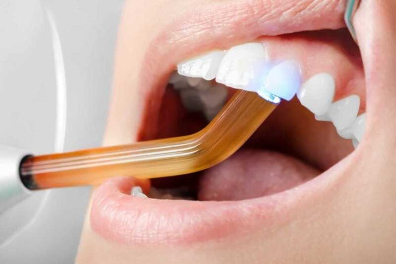 Giá hàn răng Hưng Yên – Bí quyết chọn nha khoa uy tín, chi phí hợp lý