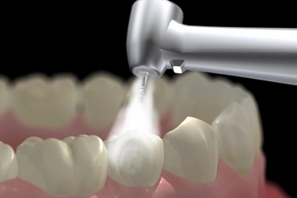Hàn răng Fuji Hưng Yên Giải pháp trám răng bền đẹp và an toàn