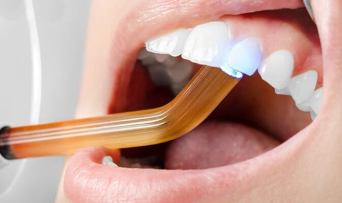 Hàn răng có bền không Yếu tố quyết định độ bền miếng trám