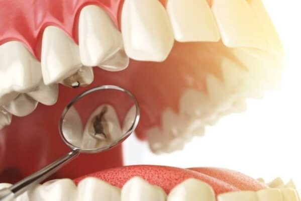 Hàn răng sâu Hưng Yên bằng công nghệ mới – Giữ răng bền đẹp lâu dài