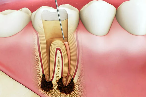Khi nào cần điều trị tủy bọc răng sứ