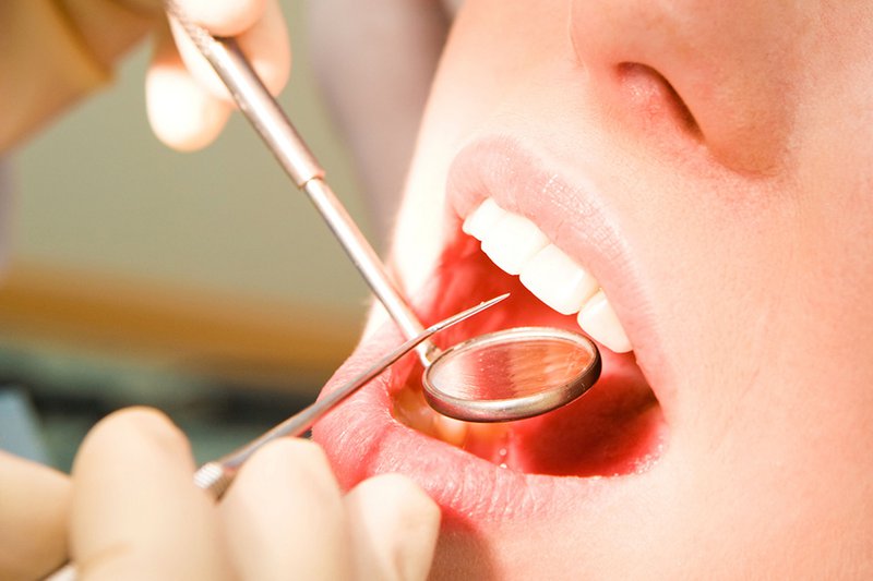 Hàn răng sâu Thái Bình – Dịch vụ nha khoa được nhiều người tin chọn 1 Khi nào cần hàn răng sâu