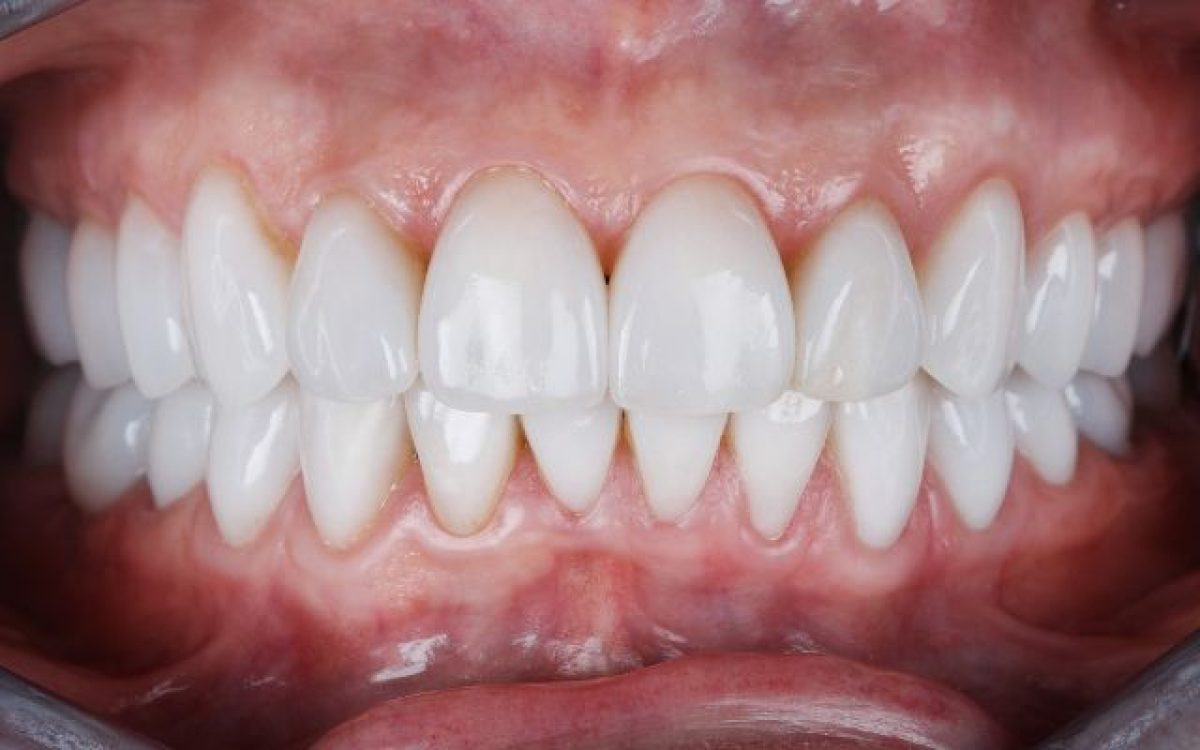 Lựa chọn nha khoa uy tín để điều trị răng sứ bị viêm