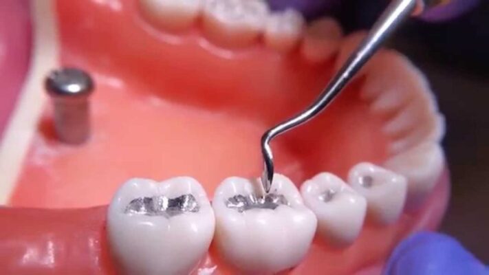 Hàn răng sâu Thái Bình – Dịch vụ nha khoa được nhiều người tin chọn 3 Nha Khoa Ngọc – Địa chỉ hàn răng sâu Thái Bình uy tín