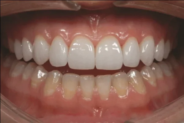 Quy trình điều trị răng sứ Những điều bạn cần biết trước khi thực hiện
