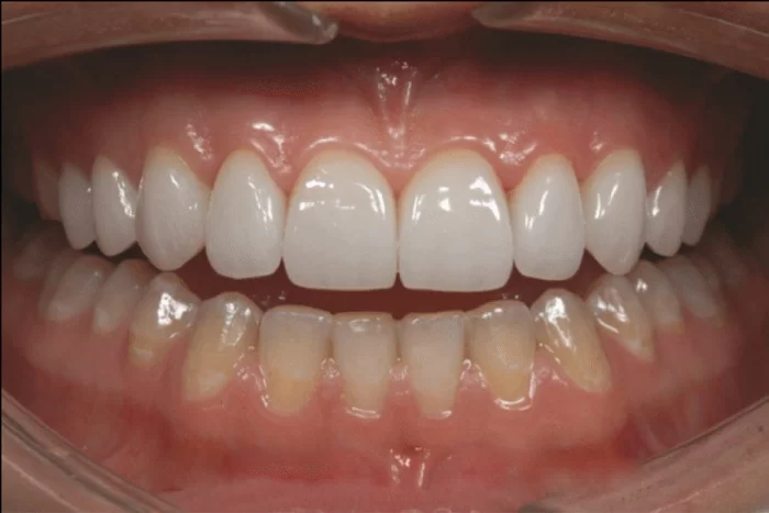 Quy trình điều trị răng sứ Những điều bạn cần biết trước khi thực hiện