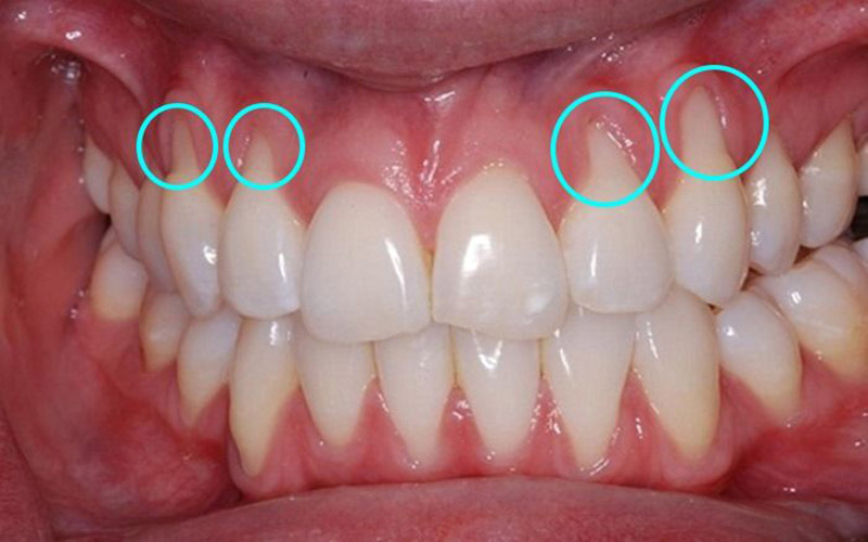 Quy trình điều trị răng sứ bị viêm chi tiết từ A đến Z
