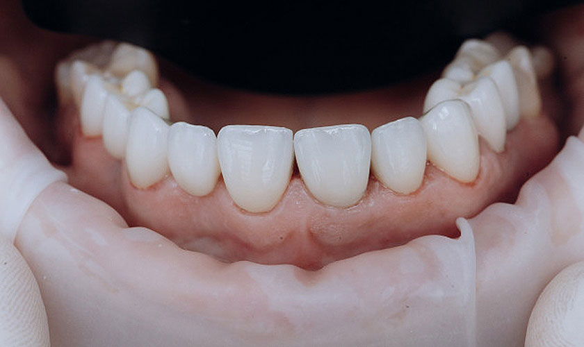 Quy trình điều trị răng sứ chi tiết