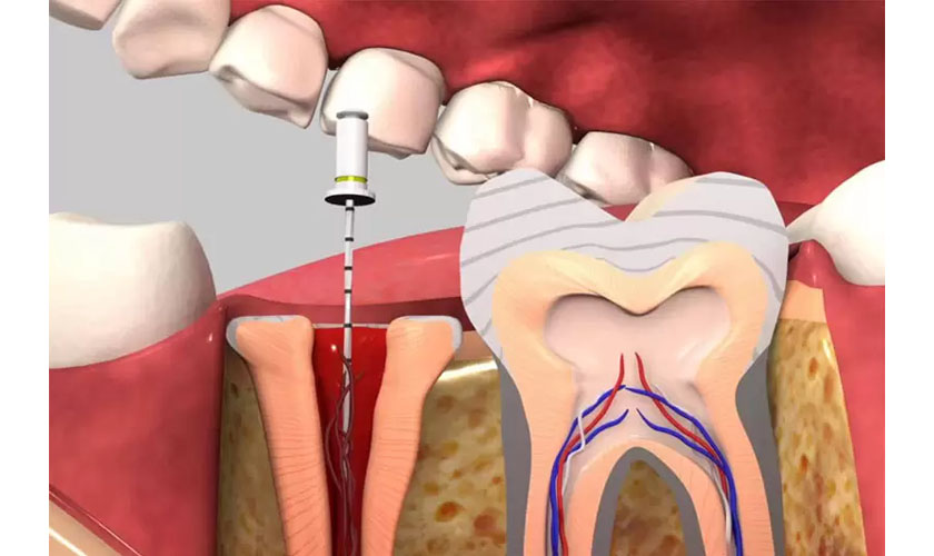 Quy trình điều trị tủy bọc răng sứ