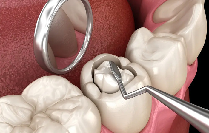 Quy trình hàn răng Fuji Hưng Yên