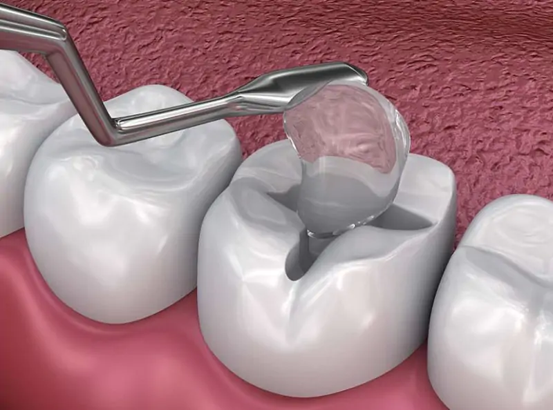 Quy trình hàn răng sâu tại nha khoa ở Hưng Yên