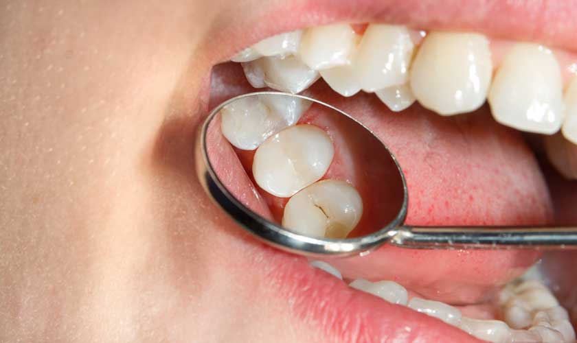 Hàn răng sâu Thái Bình – Dịch vụ nha khoa được nhiều người tin chọn 2 Quy trình hàn răng sâu tại nha khoa uy tín ở Thái Bình