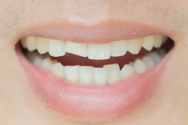 Review địa chỉ hàn răng cửa bị mẻ Hưng Yên được nhiều khách hàng tin chọn