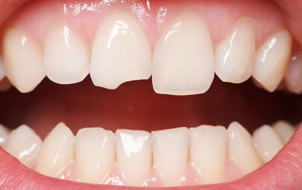 Tại sao nên hàn răng cửa khi bị mẻ