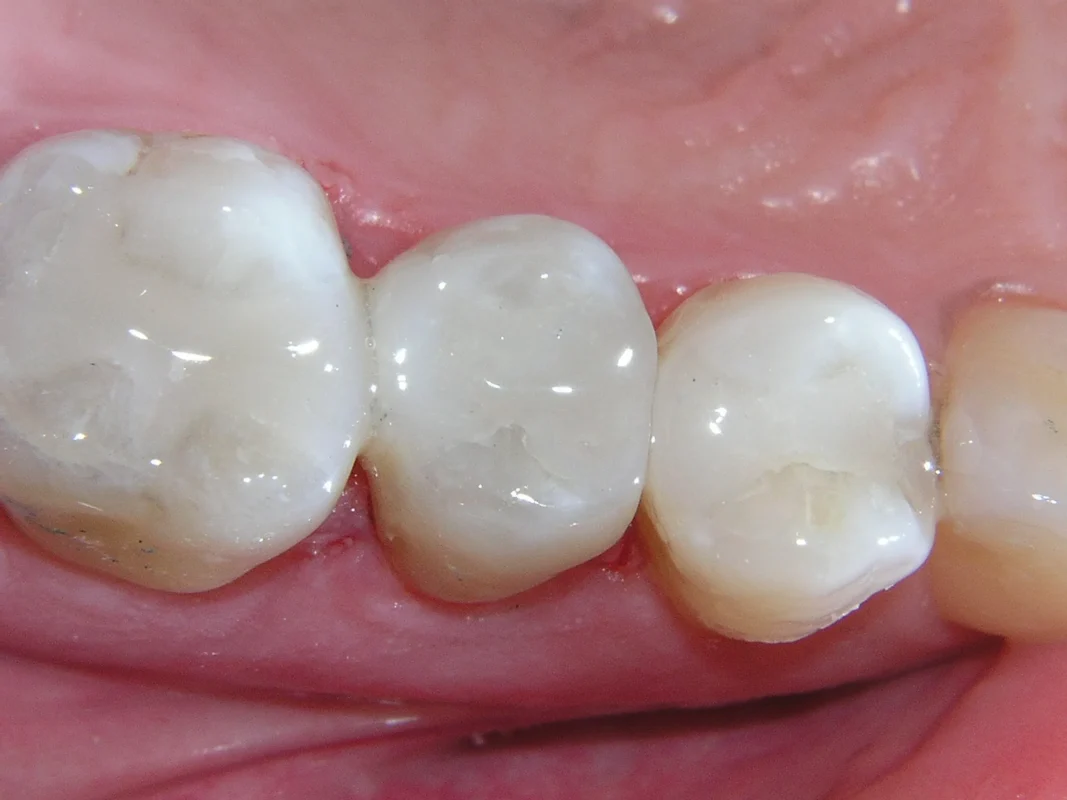 Ưu điểm của công nghệ hàn răng sâu hiện đại