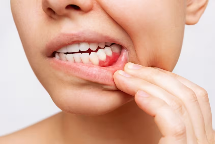 Cách chăm sóc răng miệng để hạn chế viêm lợi quanh cầu răng sứ