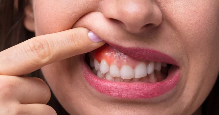 Cách xử lý khi lợi bị đỏ và sưng đau quanh răng sứ