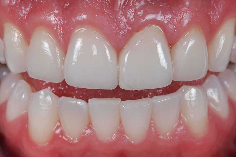 Dấu hiệu nhận biết răng sứ bị viêm lợi và lung lay