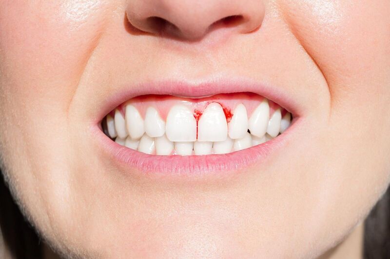Dấu hiệu nhận biết viêm lợi răng sứ titan