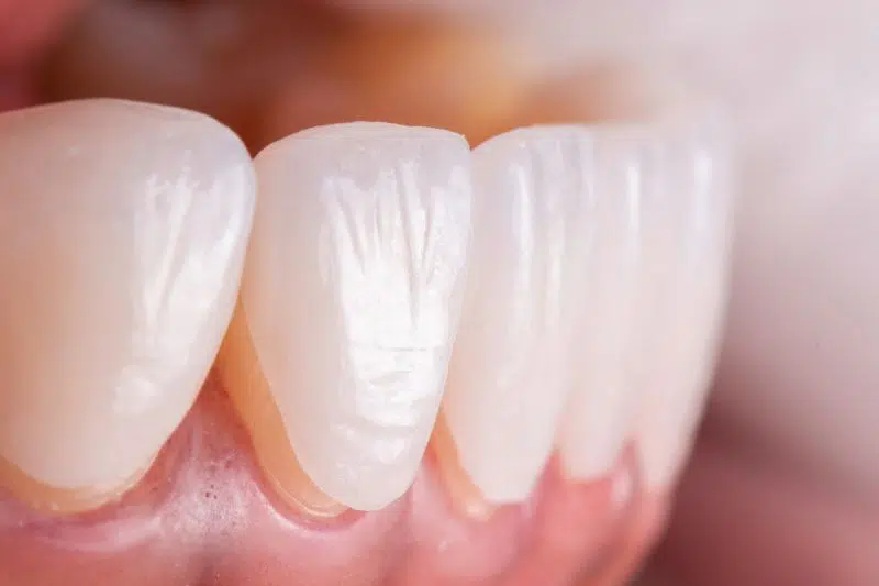 Kỹ thuật bọc răng sứ sai cũng là nguyên nhân răng sứ bị đỏ lợi và sưng đau