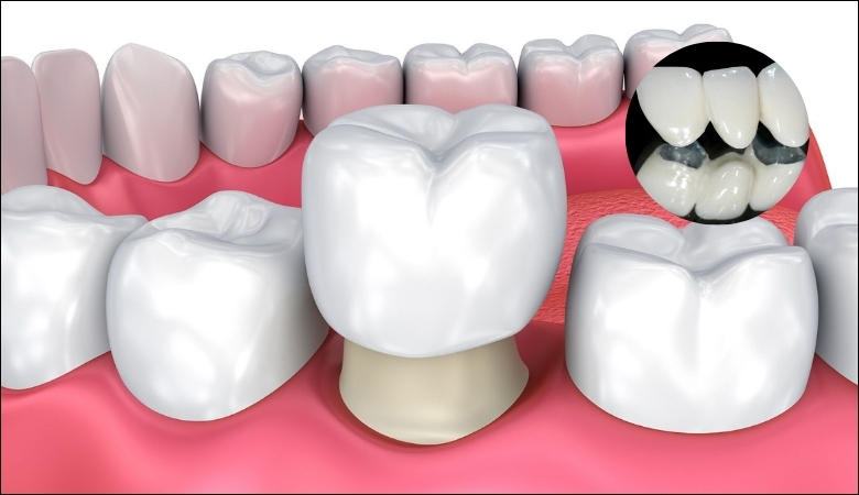 Lựa chọn địa chỉ uy tín để bọc răng sứ