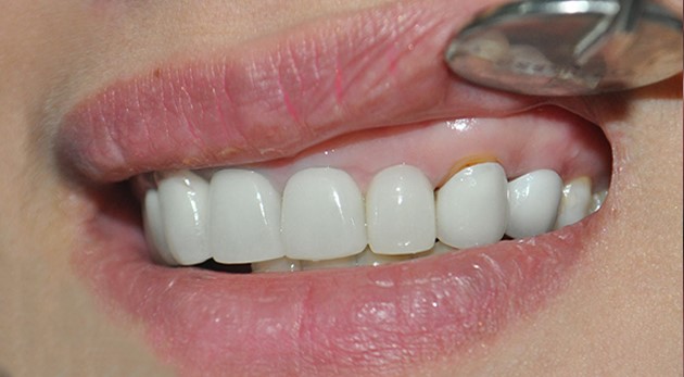 Giải pháp khắc phục tình trạng răng sứ bị tụt lợi và viêm lợi 2 Nguyên nhân dẫn đến răng sứ bị tụt lợi và viêm lợi