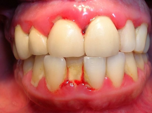 Nguyên nhân răng sứ bị đỏ lợi và sưng đau