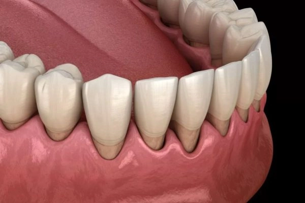 Những sai lầm dễ gây viêm lợi sau bọc răng sứ