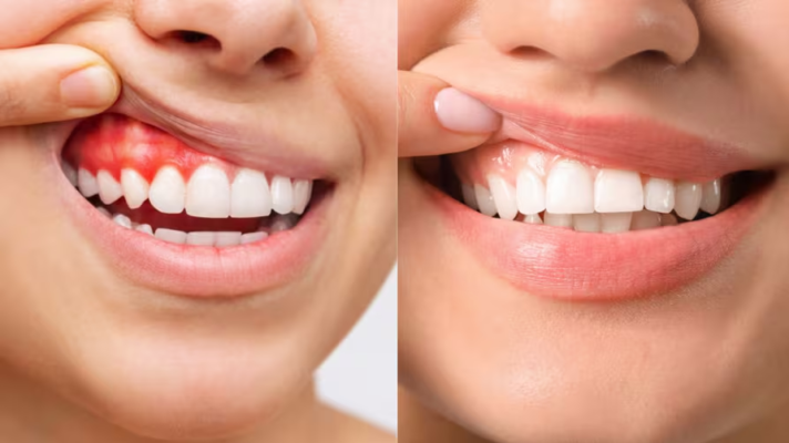 Quy trình nha khoa điều trị viêm lợi răng sứ chuyên nghiệp