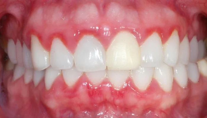 Răng sứ bị đỏ lợi và sưng đau – Biến chứng không nên chủ quan