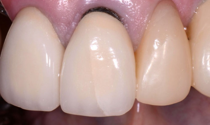 Răng sứ bị lỏng và lung lay