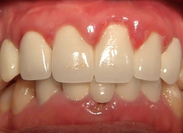 Giải pháp khắc phục tình trạng răng sứ bị tụt lợi và viêm lợi 1 Răng sứ bị tụt lợi và viêm lợi