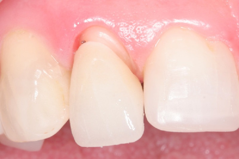 Răng sứ bị viêm lợi và lung lay Nguyên nhân, dấu hiệu và cách xử lý