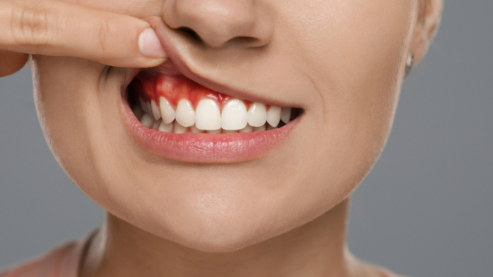 Viêm lợi răng sứ khám ở đâu tốt Kinh nghiệm lựa chọn nha khoa uy tín