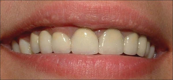 Viêm lợi răng sứ titan Dấu hiệu nhận biết và hướng điều trị