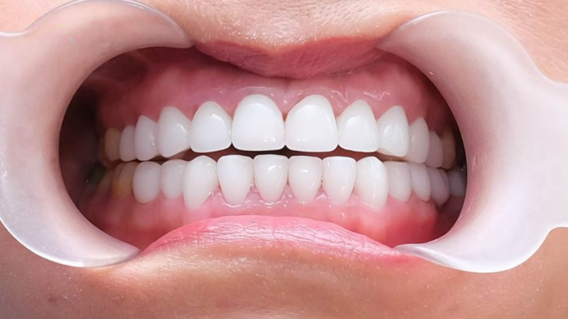 Viêm lợi răng sứ Zirconia là gì? Nguyên nhân và cách khắc phục hiệu quả 2 Cách khắc phục viêm lợi răng sứ Zirconia hiệu quả