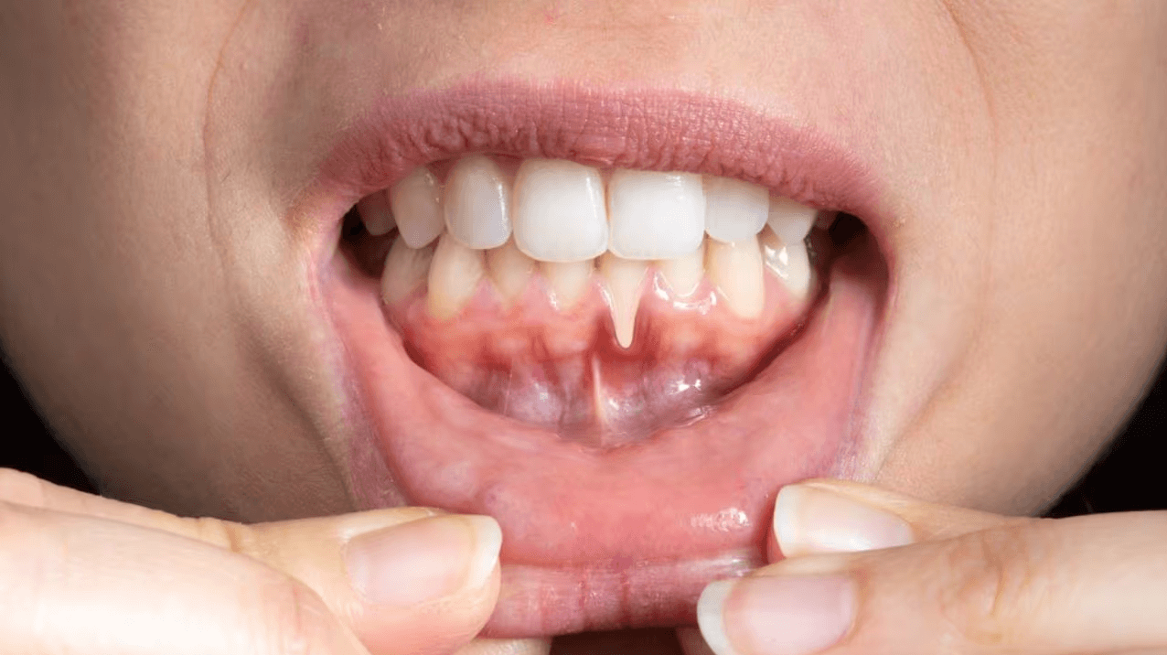 Chi phí điều trị viêm lợi răng sứ Cập nhật mới nhất hiện nay