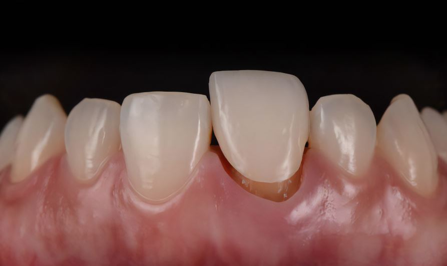 Răng sứ bị hở kẽ dắt thức ăn – Dấu hiệu cảnh báo cần xử lý sớm 1 Dấu hiệu nhận biết răng sứ bị hở kẽ dắt thức ăn