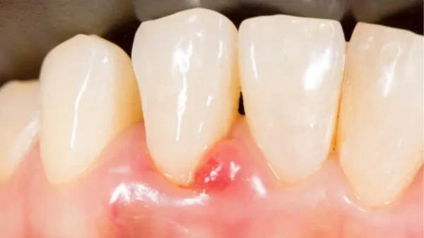 Dấu hiệu nhận biết răng sứ bị viêm