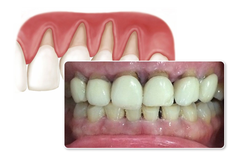 Dấu hiệu nhận biết viêm lợi răng sứ