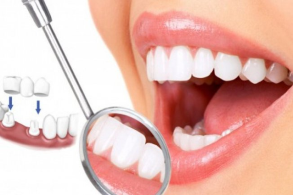 Điều trị viêm lợi do răng sứ Lời khuyên từ bác sĩ nha khoa