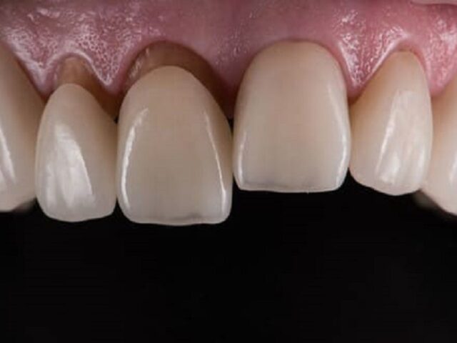 Răng sứ bị hở kẽ dắt thức ăn – Dấu hiệu cảnh báo cần xử lý sớm 2 Khe hở răng sứ làm cho thức ăn dắt vào kẽ răng