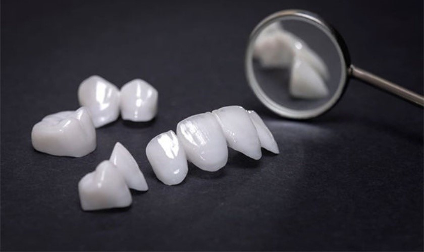 Thay mão răng sứ bị nhét thức ăn – Giải pháp khắc phục triệt để tình trạng hở kẽ 3 Lợi ích sau khi thay mão răng sứ