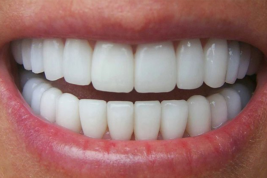 Viêm lợi răng sứ Zirconia là gì? Nguyên nhân và cách khắc phục hiệu quả 1 Nguyên nhân gây viêm lợi răng sứ Zirconia