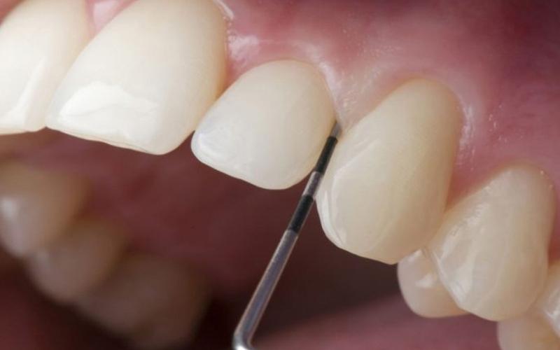 Chi phí điều trị viêm lợi răng sứ: Cập nhật mới nhất hiện nay 1 Nguyên nhân gây viêm lợi răng sứ