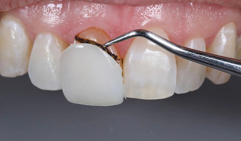 Nha Khoa Ngọc - Nha khoa điều trị răng sứ bị dắt thức ăn uy tín hiện nay 1 Nguyên nhân khiến răng sứ bị dắt thức ăn