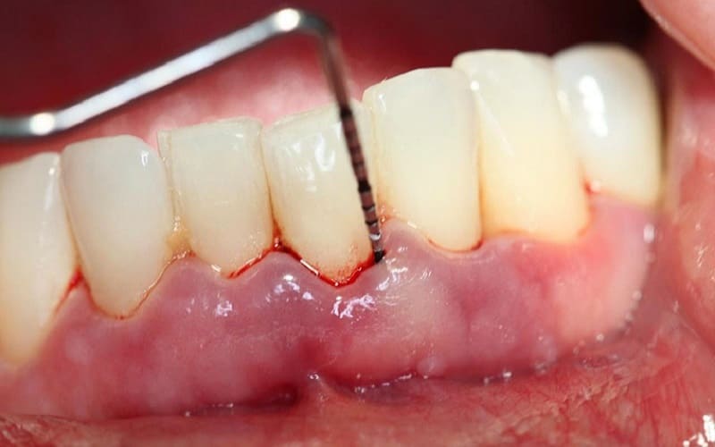 Nguyên nhân khiến răng sứ bị viêm lợi
