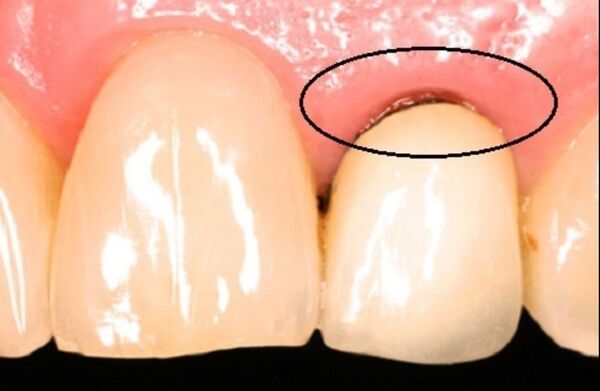 Răng sứ bị hở kẽ dắt thức ăn – Dấu hiệu cảnh báo cần xử lý sớm